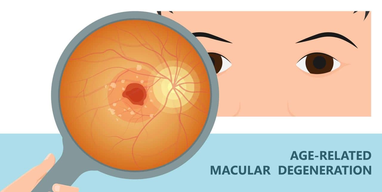 Thoái hóa điểm vàng - Một trong các bệnh về mắt phổ biến ở người cao tuổi 