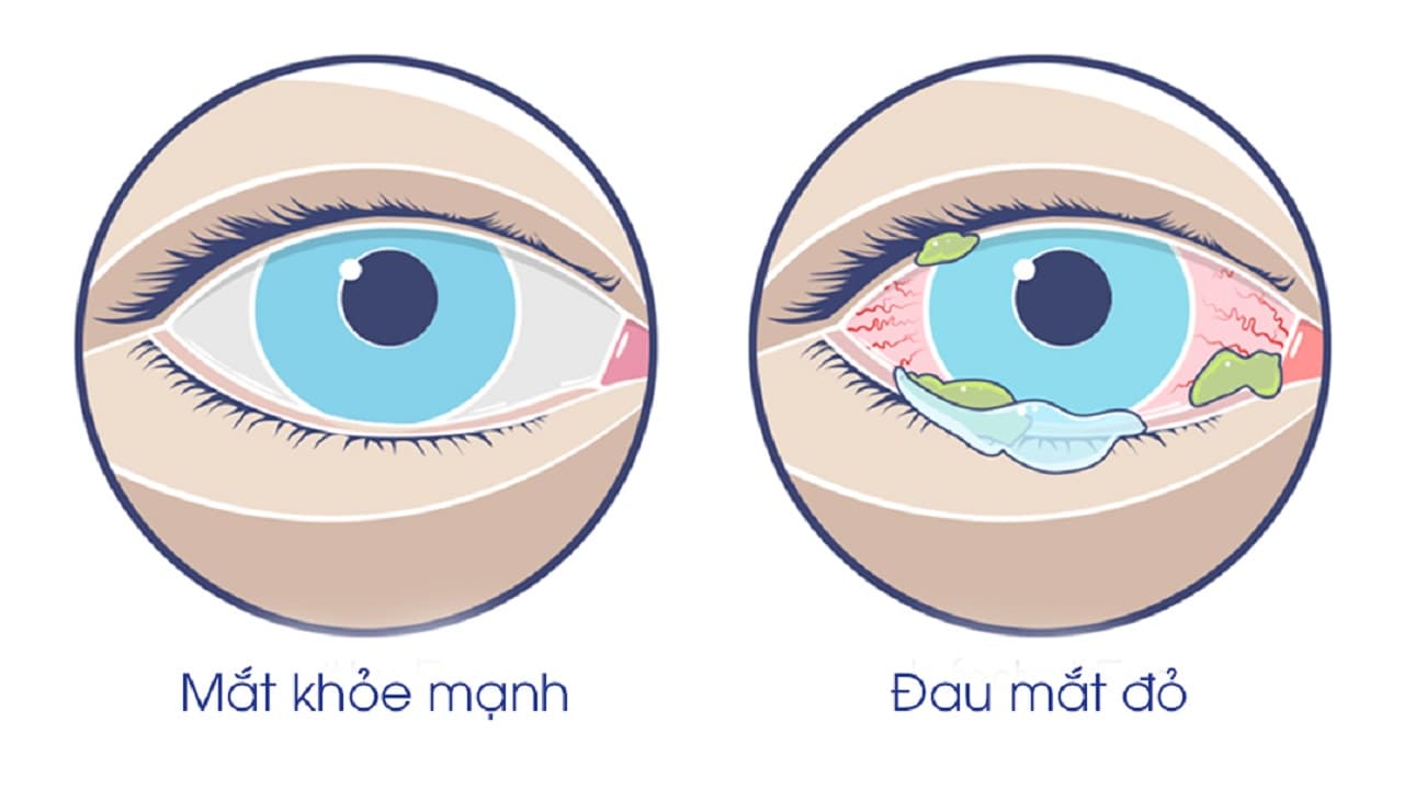 Tổng hợp các cách phòng bệnh đau mắt đỏ cực hiệu quả 