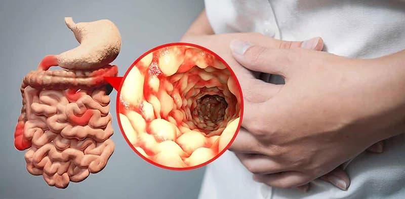 Bệnh Crohn là gì?