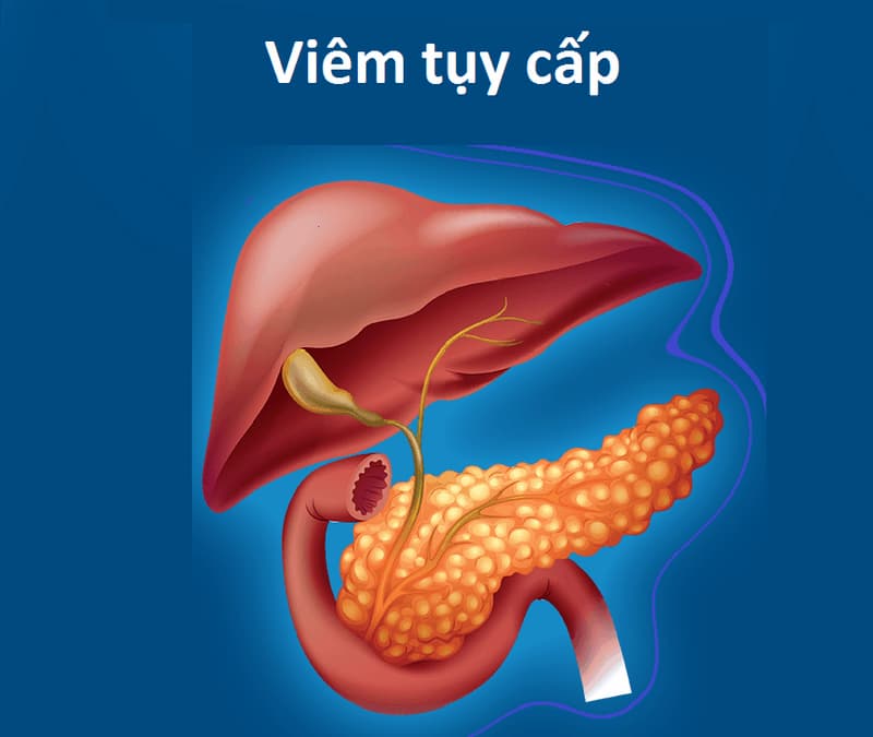 Bệnh viêm tụy: Nguyên nhân, dấu hiệu và cách điều trị