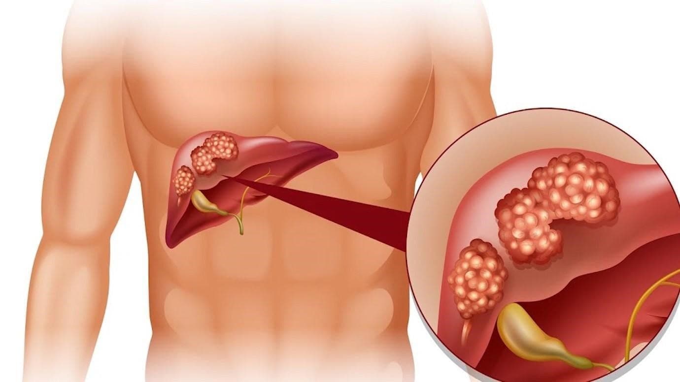 Những triệu chứng bệnh gan phổ biến nhất mà bạn cần nắm được để phòng ngừa